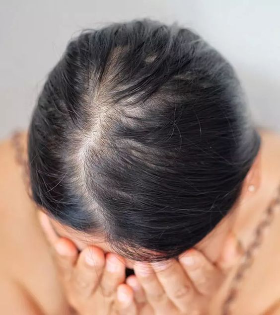 What Vitamin Deficiency Causes Hair Loss